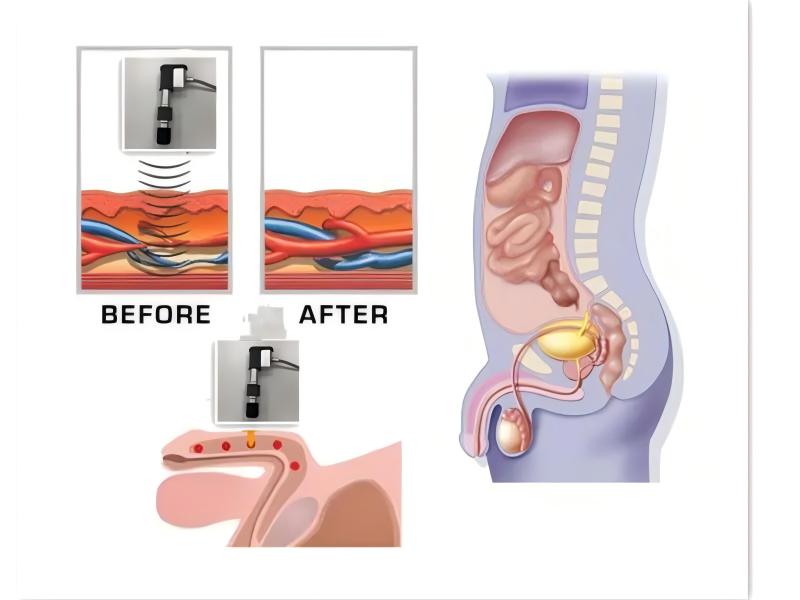 3 in 1 shockwave tecar therapy machine