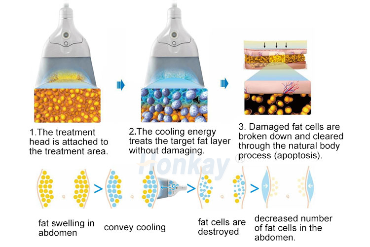 Fat Freezing Cryotherapy Slimming Machine