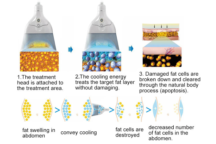 fat freeze lose weight